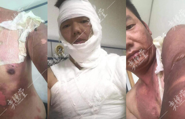 深三度烫伤的刘同利_奕德堂中医