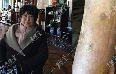 患有红斑狼疮的黄玉婷_奕德堂中医