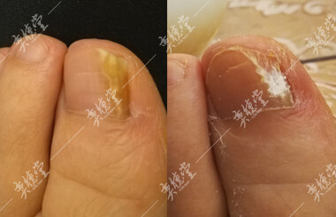 灰指甲_奕德堂中医