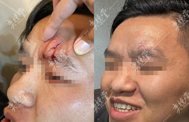 左眉骨开放性撕裂伤的王先生_奕德堂中医