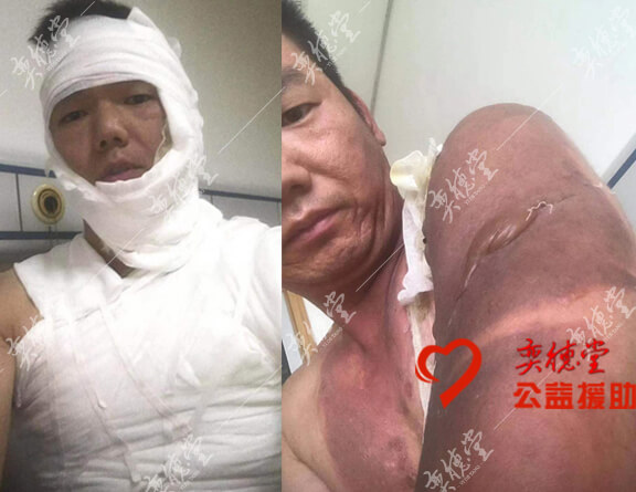 深三度烫伤的刘同利_奕德堂中医