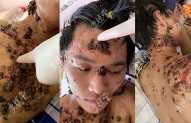 患有罕见身体菜花状毒瘤的曲艺博_奕德堂中医