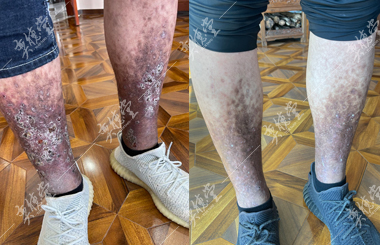 患有不明原因皮肤怪病的帅帅_奕德堂中医